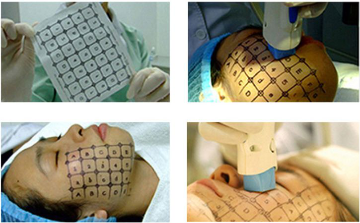 熱(rè)瑪吉5代Thermage FLX——風(fēng)靡娛樂圈抗衰神器